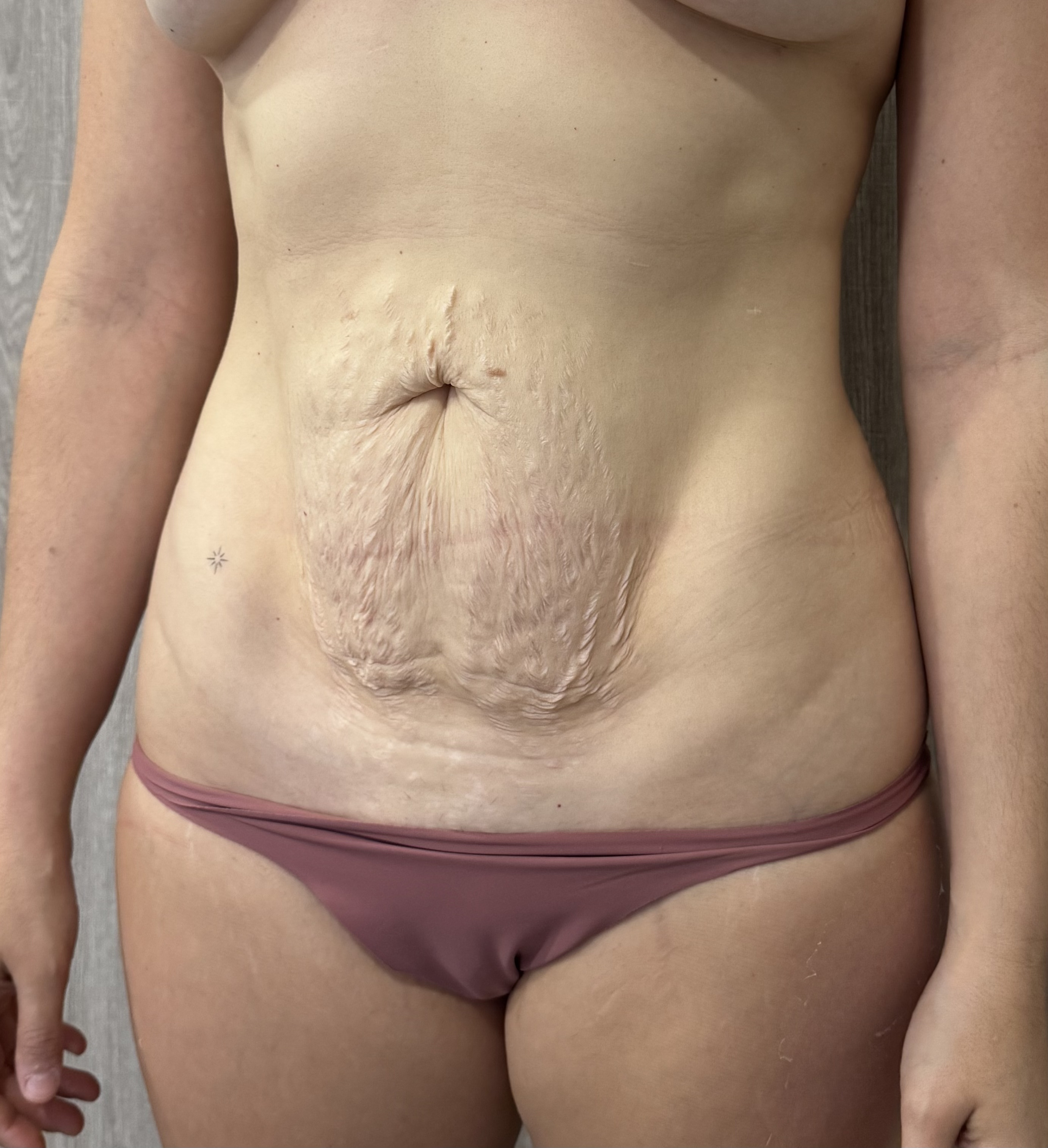 Antes de abdominoplastia