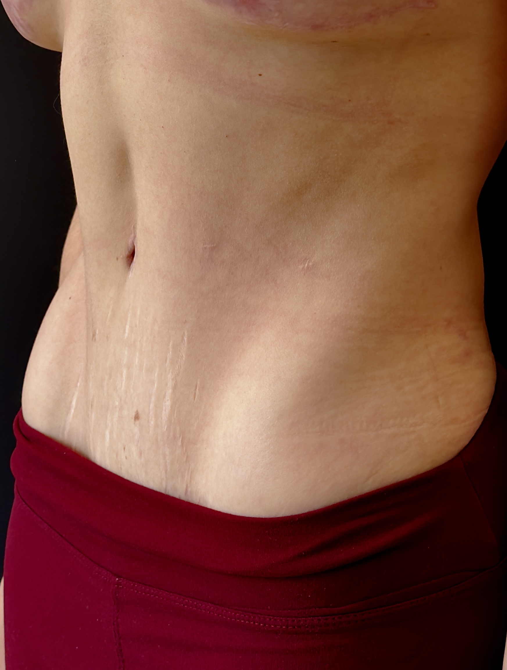 Abdominoplastia en CDMX — Dr. Francisco López Torres