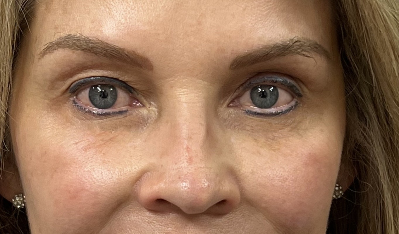 Antes de blefaroplastia