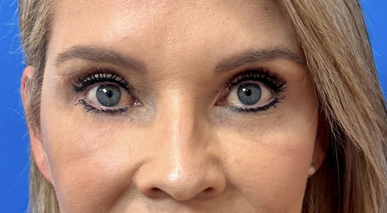 Blefaroplastia en CDMX — Dr. Francisco López Torres