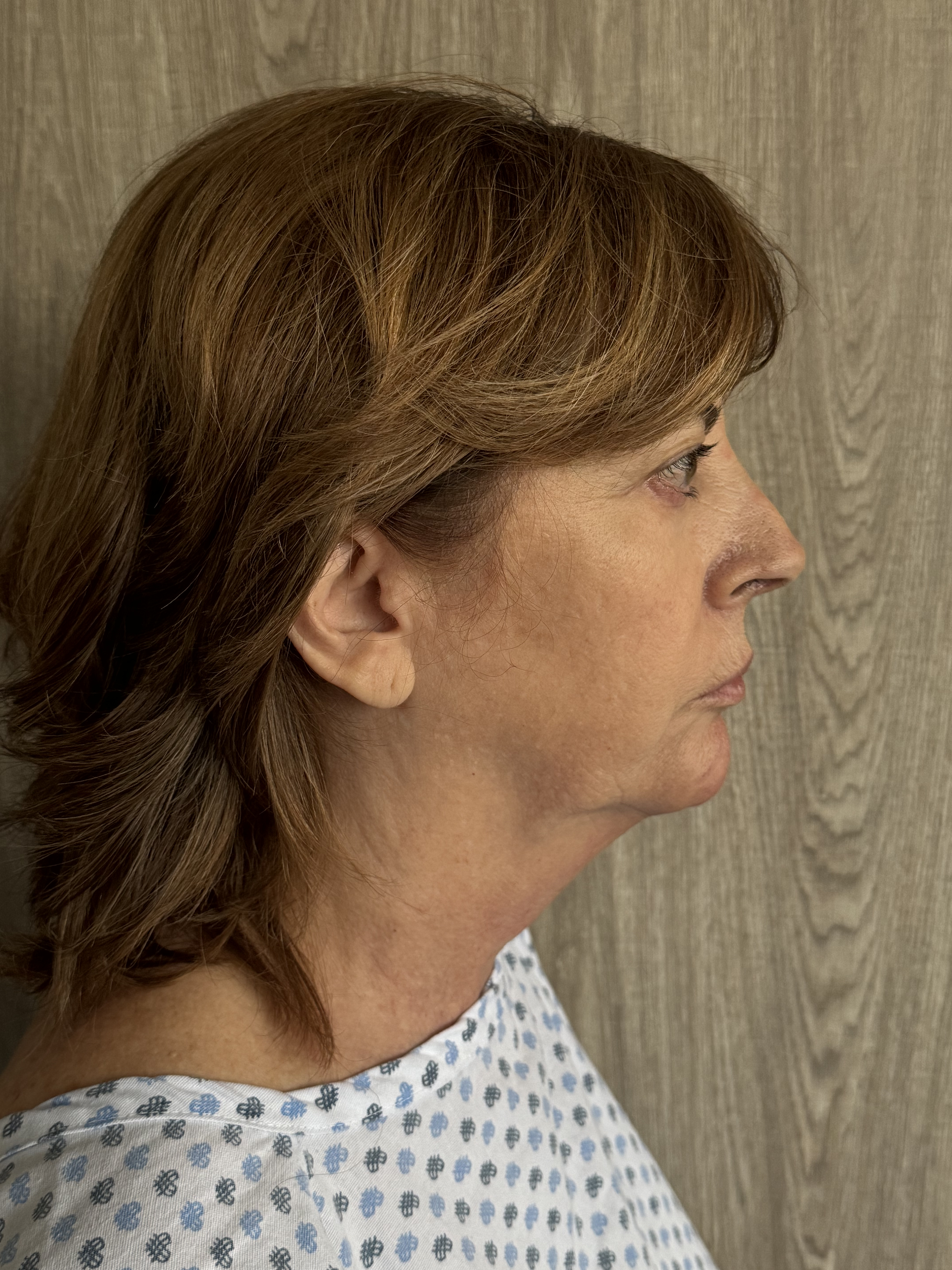 Antes de facelift