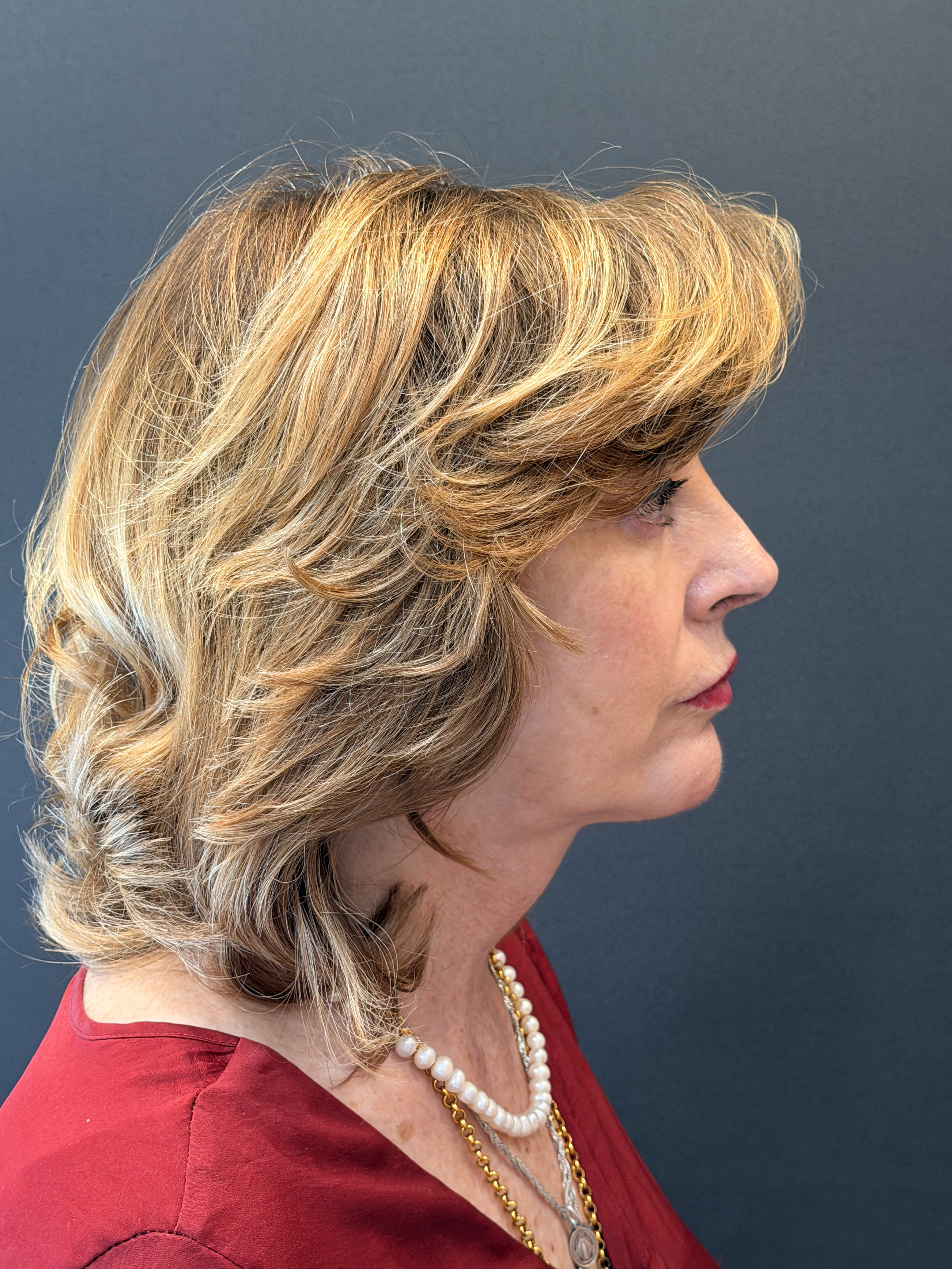 Estiramiento facial (Facelift) en CDMX — Dr. Francisco López Torres
