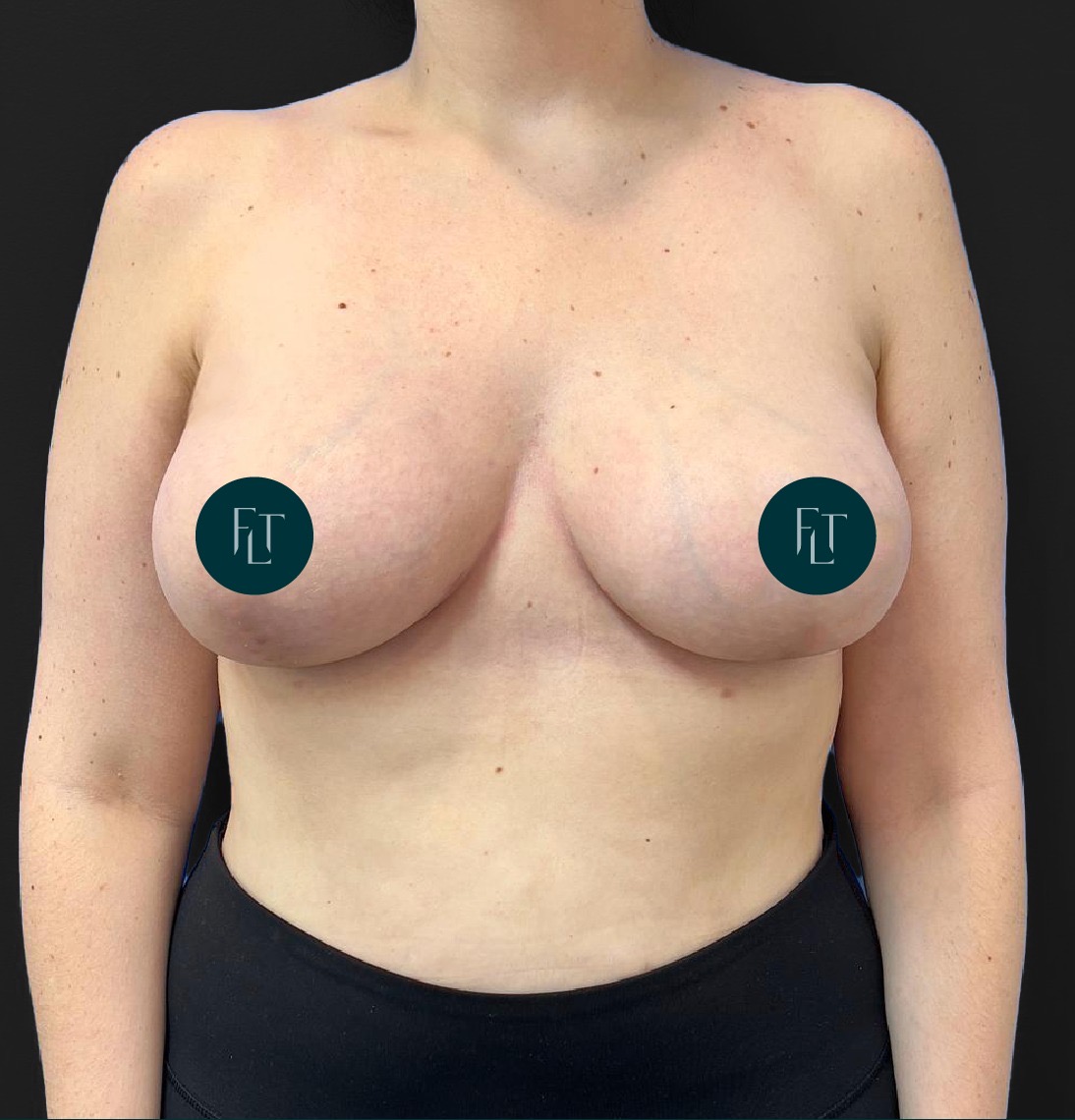 Mastopexia en CDMX — Dr. Francisco López Torres