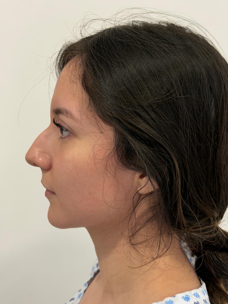Antes de la rinoplastia