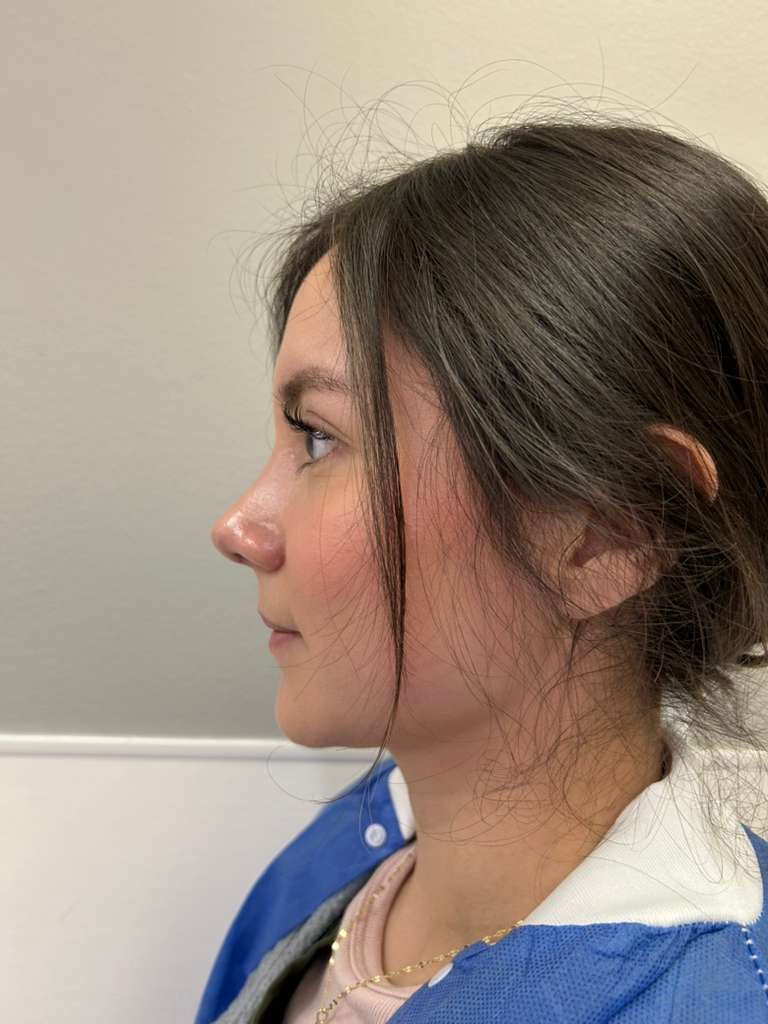 Rinoplastia en CDMX — Dr. Francisco López Torres